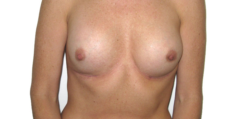 photo showing results after complex breast implant procedure showing a even corrective breast